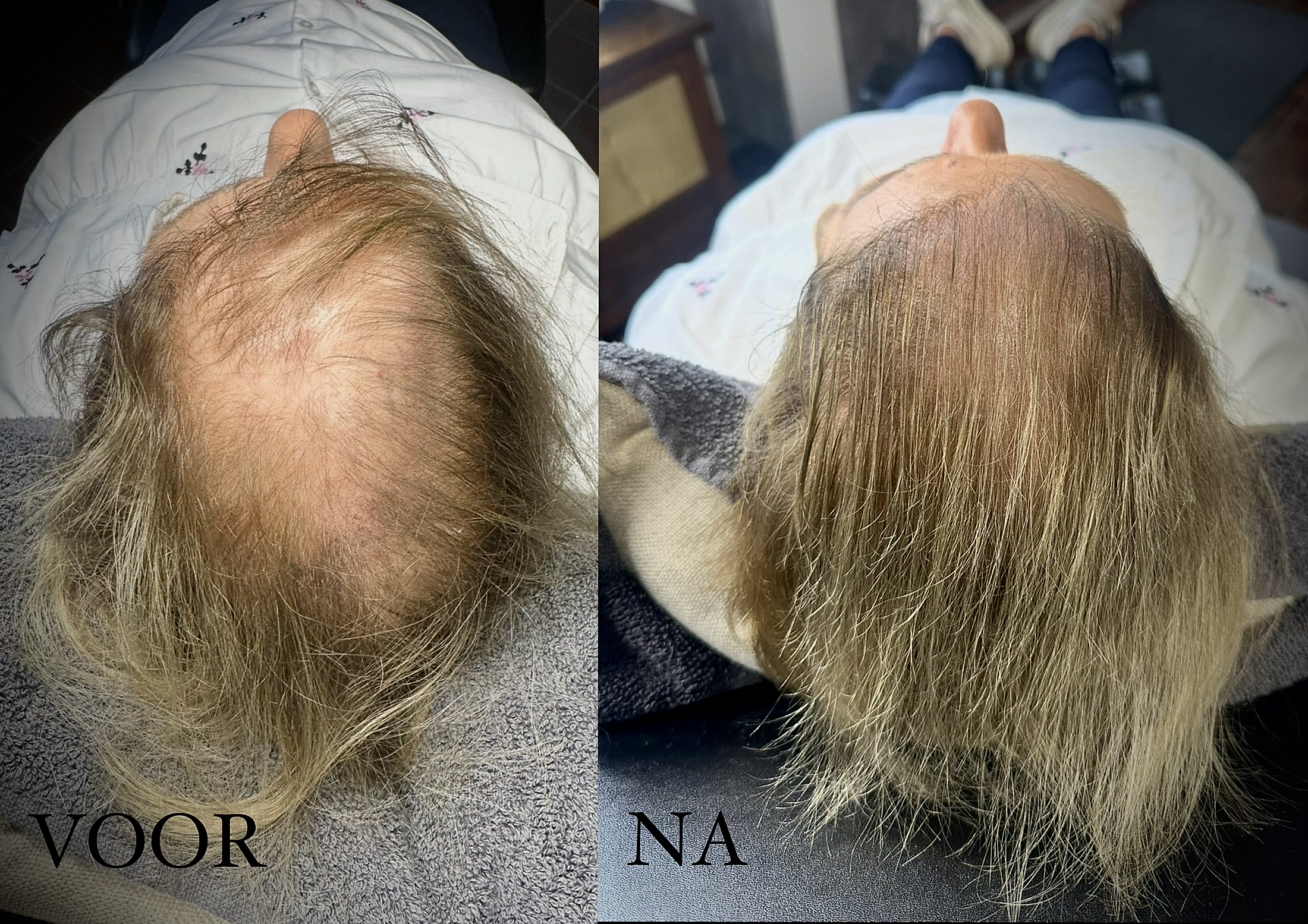 Haarpigmentatie voor kale plekken voor en na