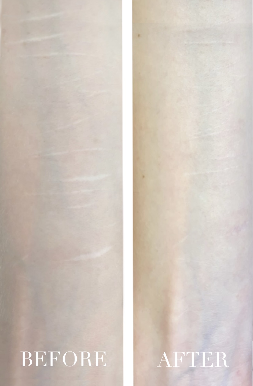 Littekencamouflage arm voor en na