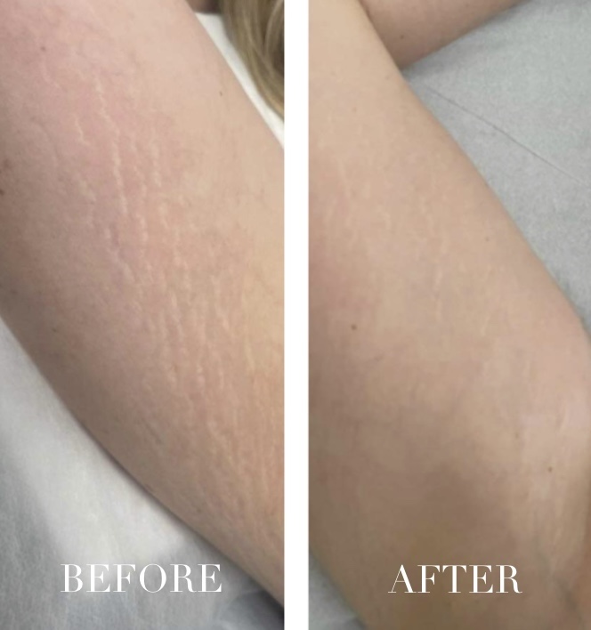 Striae en huidcamouflage voor en na